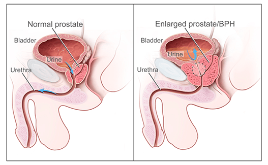 Normal prostate vs benign prostatic hyperplasia
