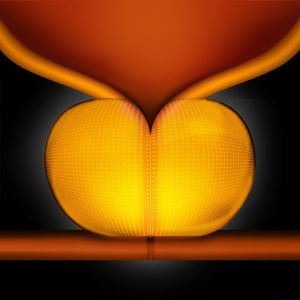 Image of an enlarged prostate