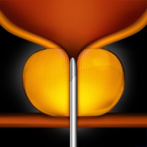 Step 1 - The UroLift® System