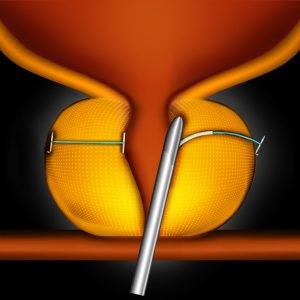 Step 2 - The UroLift® System