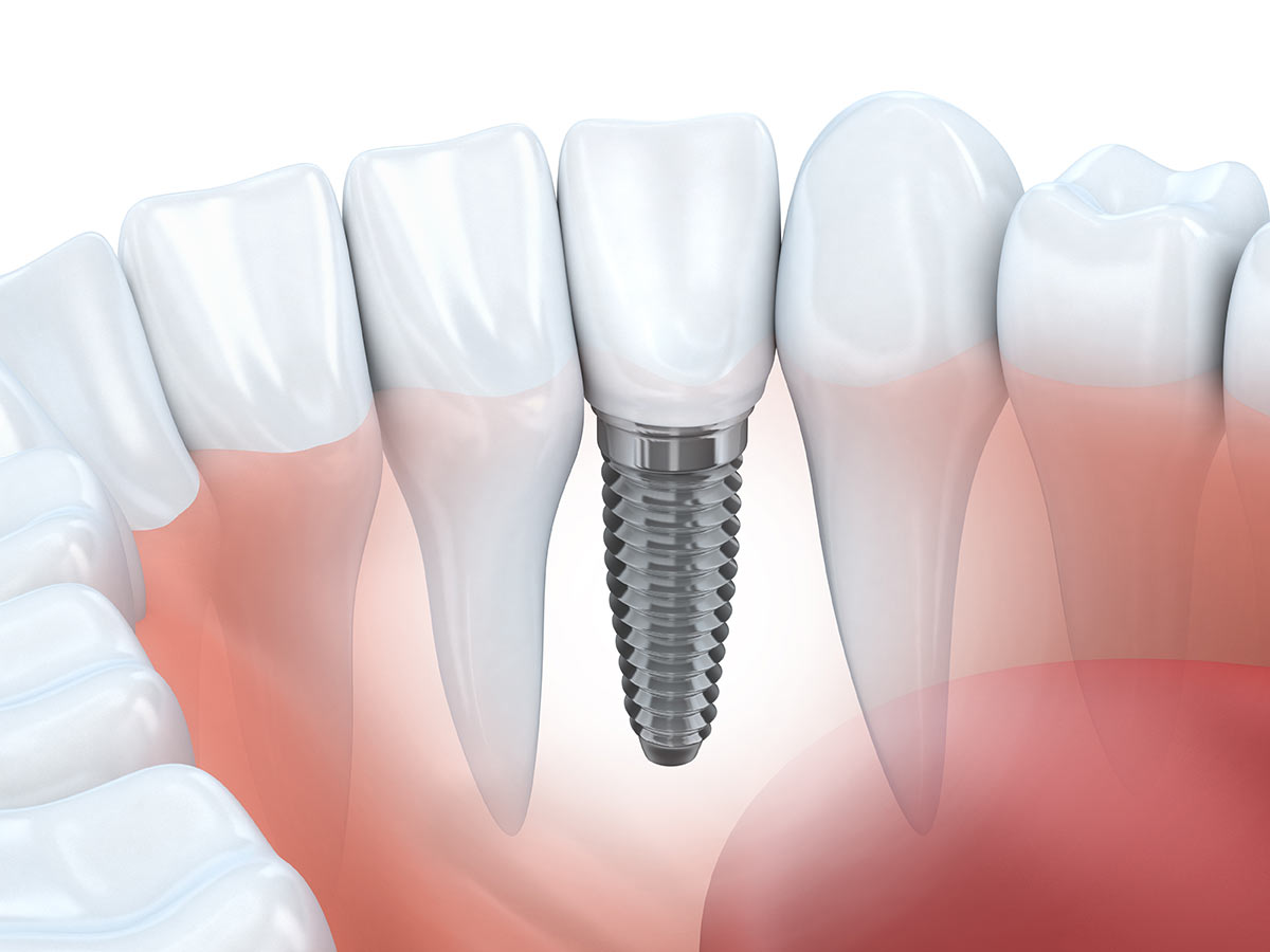 Dental Implants Apple Tree Dental Rexburg, ID