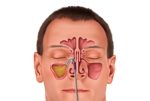 Diagram of catheter and balloon placement for balloon sinuplasty.