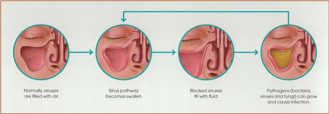 Sequential diagrams of stages of sinus health.