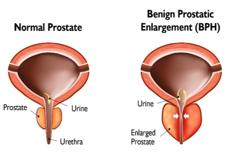 BPH and Your Urinary Health