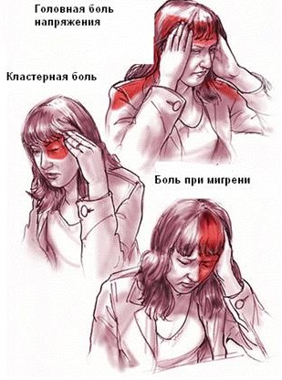 Головная боль напряжения