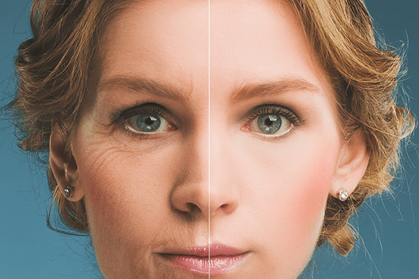 Postitive effects of non-surgical Botox