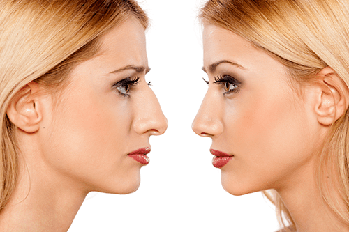 Rhinoplasty surgery candidate