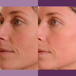 Halo Procedure, before and after results