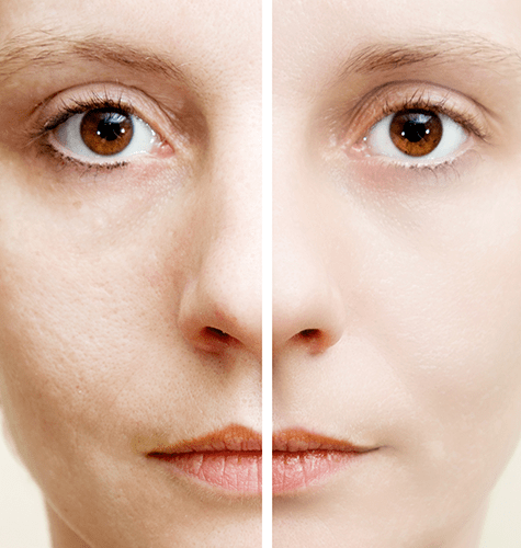 Reverse your skin's natural aging with SkinPen and PRP