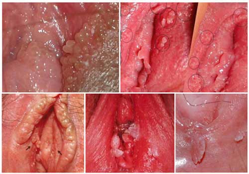 Biểu hiện bệnh sùi mào gà ở nữ