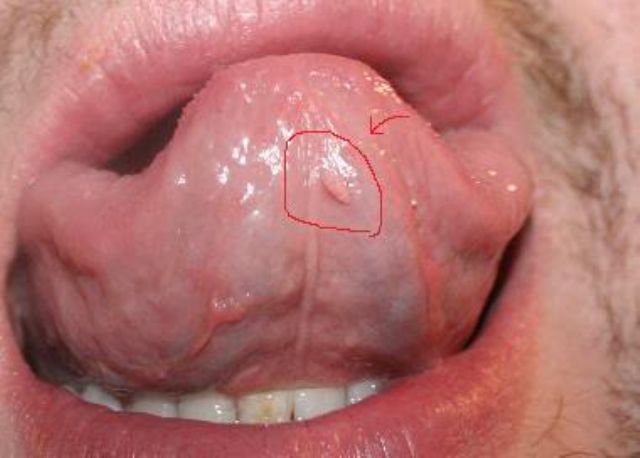 Bệnh sùi mào gà ở miệng