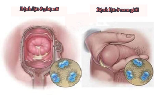 Biểu hiện của bệnh lậu