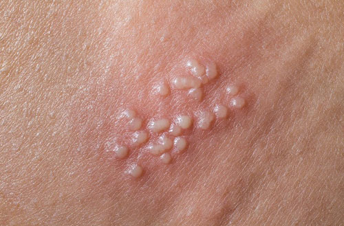 Bệnh mụn rộp sinh dục