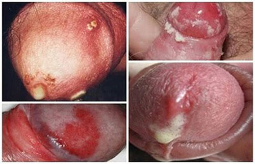 triệu chứng bệnh lậu ở nam giới