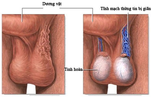 Giãn tĩnh mạch thừng tinh hoàn