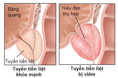 viêm tuyến tiền liệt