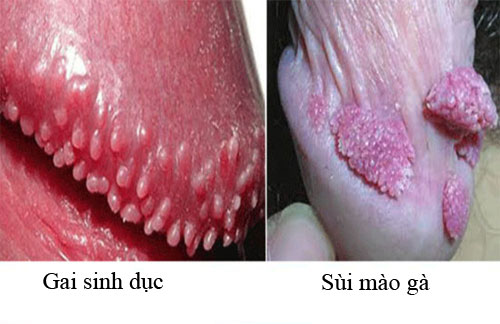 sùi mào gà và gai sinh dục có giống nhau không?