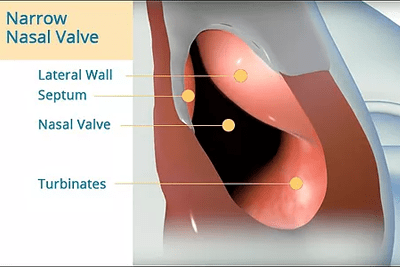 Narrow Nasal Valve
