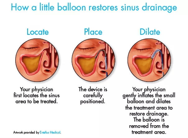 Diagram of the Balloon Sinuplasty Procedure