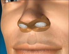 Provent Nasal Valve Treatment
