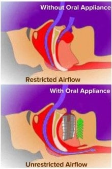 Provent Nasal Valve Treatment