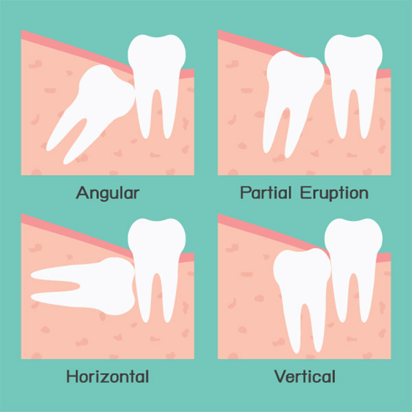 Wisdom teeth extractions