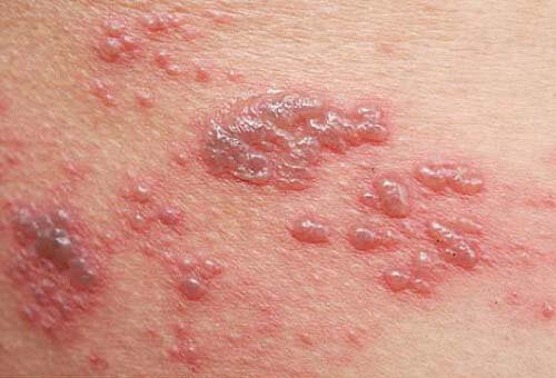 bệnh zona thần kinh là gì