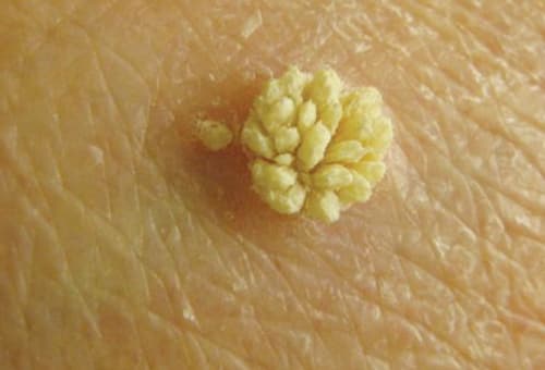điều trị mụn cơm hiệu quả