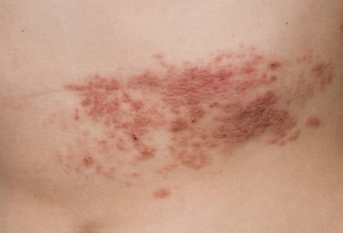 zona thần kinh có lây không?