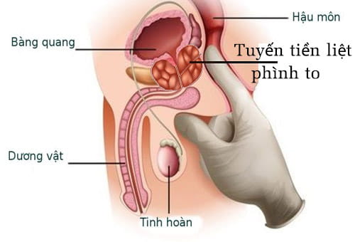 phì đại tuyến tiền liệt là gì?