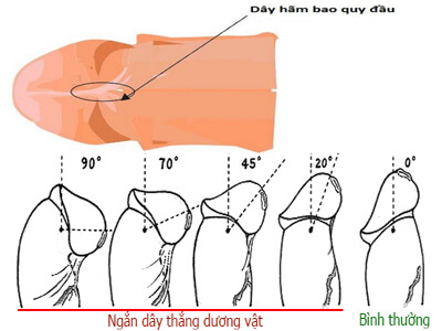 Hình ảnh đứt dây hãm bao quy đầu