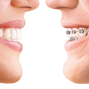 before after orthodontic treatment