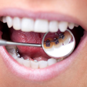 orthodontics lingual braces
