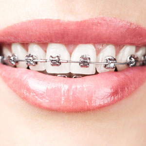traditional braces orthodontics