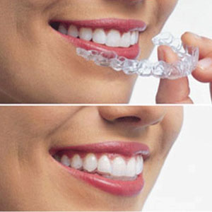 orthodontics clear aligners