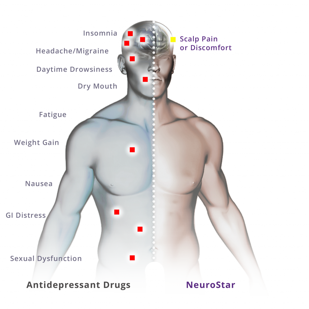 side effects of TMS diagram