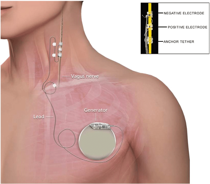 Location of Vagus Nerve Stimulation Device