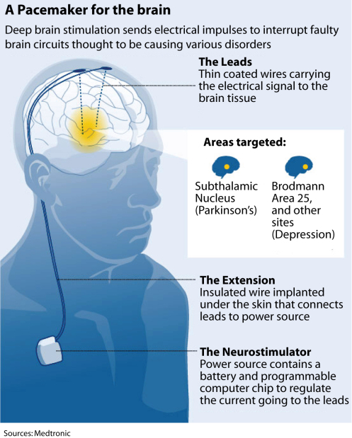 how deep brain stimulation works