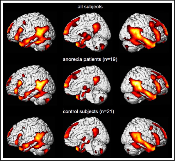brain activity scans in anorexic patients