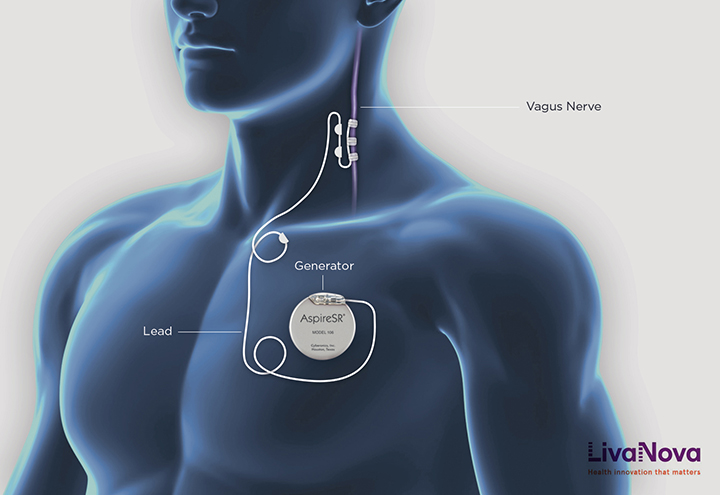 generator placement in agus nerver stimulation (VNS) device