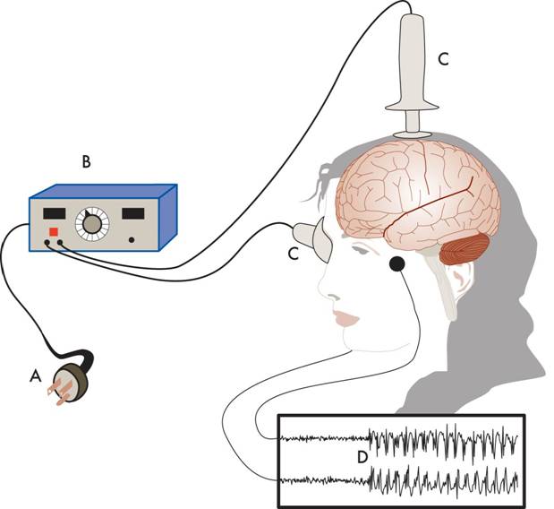 Electroconvulsive Therapy (ECT) diagram