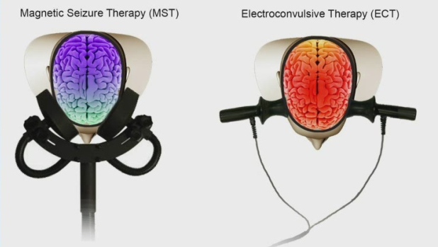 MST vs ECT equipment & process differences