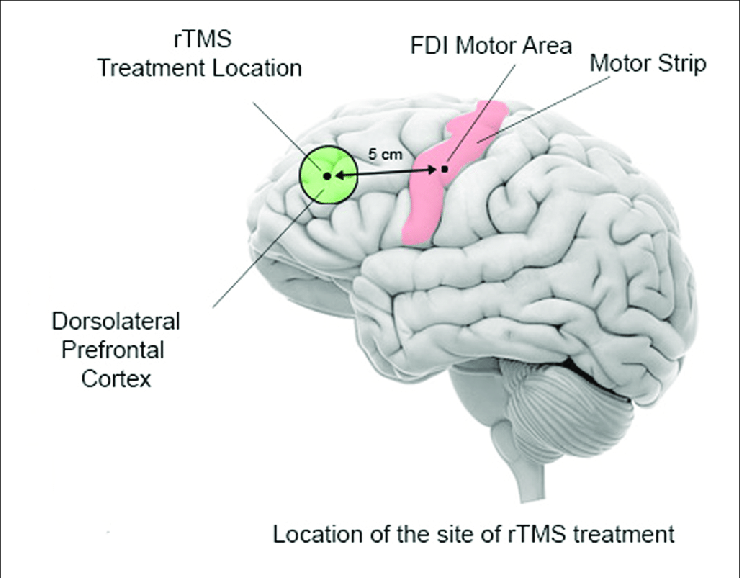 Diagram of TMS treatment location in the brain