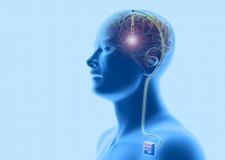 Pictured is a model of the location of the implanted device that is involved in deep brain stimulation.