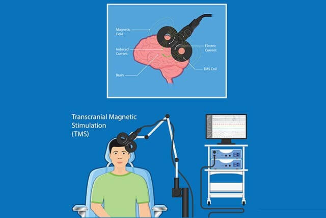 TMS procedure