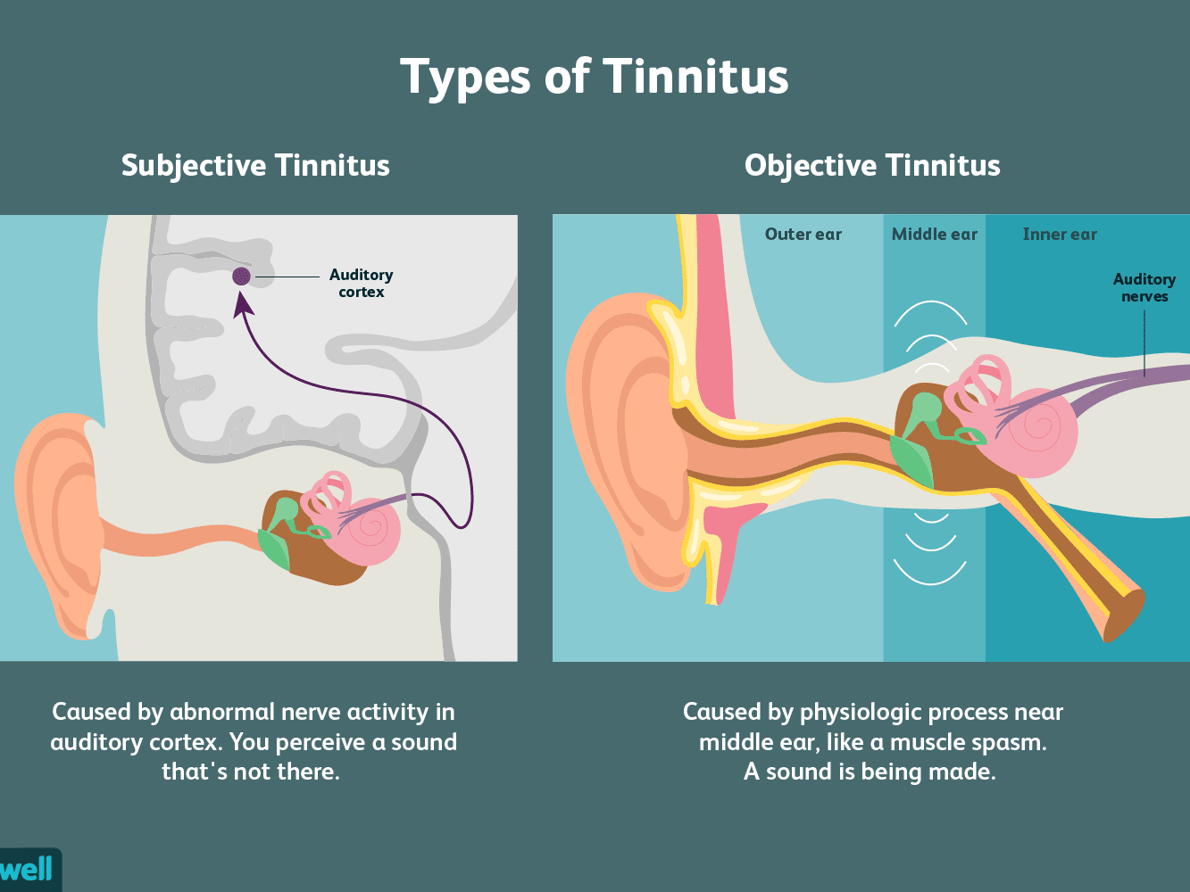 types of tinnitus