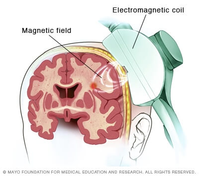 how tms works