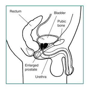 Detailed illustration of an enlarged prostate.