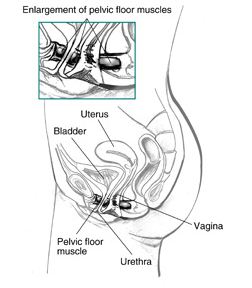 Diagram of Female Incontinence; enlargement of the pelvic floor muscles