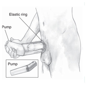 Diagram of a Treatment Method for Erectile Dysfunction